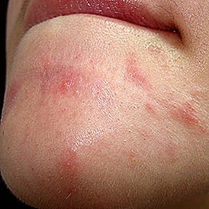 Dermatitis, perioral: MedlinePlus Medical Encyclopedia Image