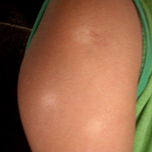 Manchas+Rojas+En+Los+Brazos home images manchas blancas leucodermia 2 manchas blancas leucodermia ...