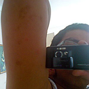 Manchas+Rojas+En+Los+Brazos ... Rojas En Los Brazos http://www.pic2fly.com/Ronchas+En+Los+Brazos.html