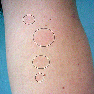 Después del embarazo la psoriasis