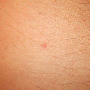 Manchas+Rojas+En+Los+Brazos Manchitas rojas en la piel que no pican ni duelen. ¿Qué pueden ser?