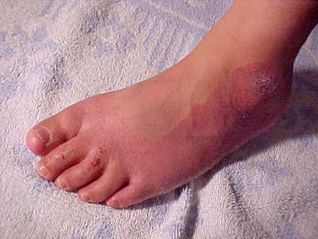 La psoriasis como curar el hinchazón