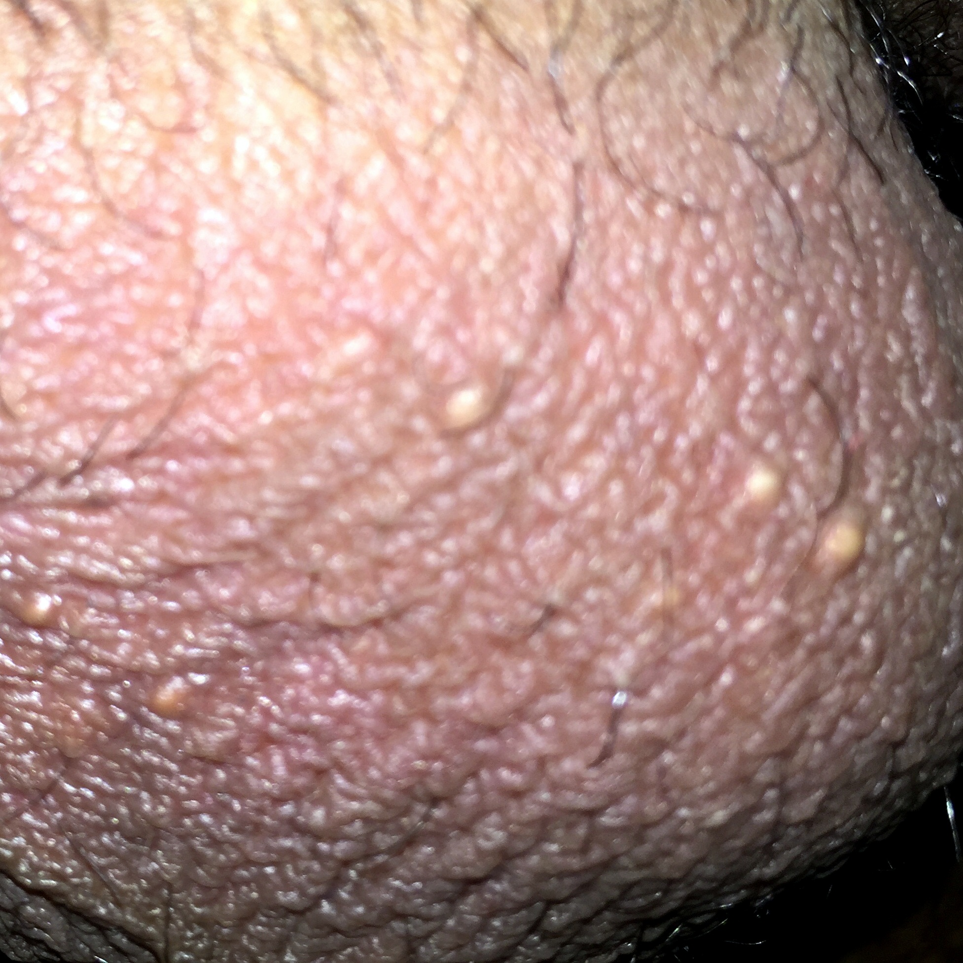El aceite shi para la cutis de la piel problemática