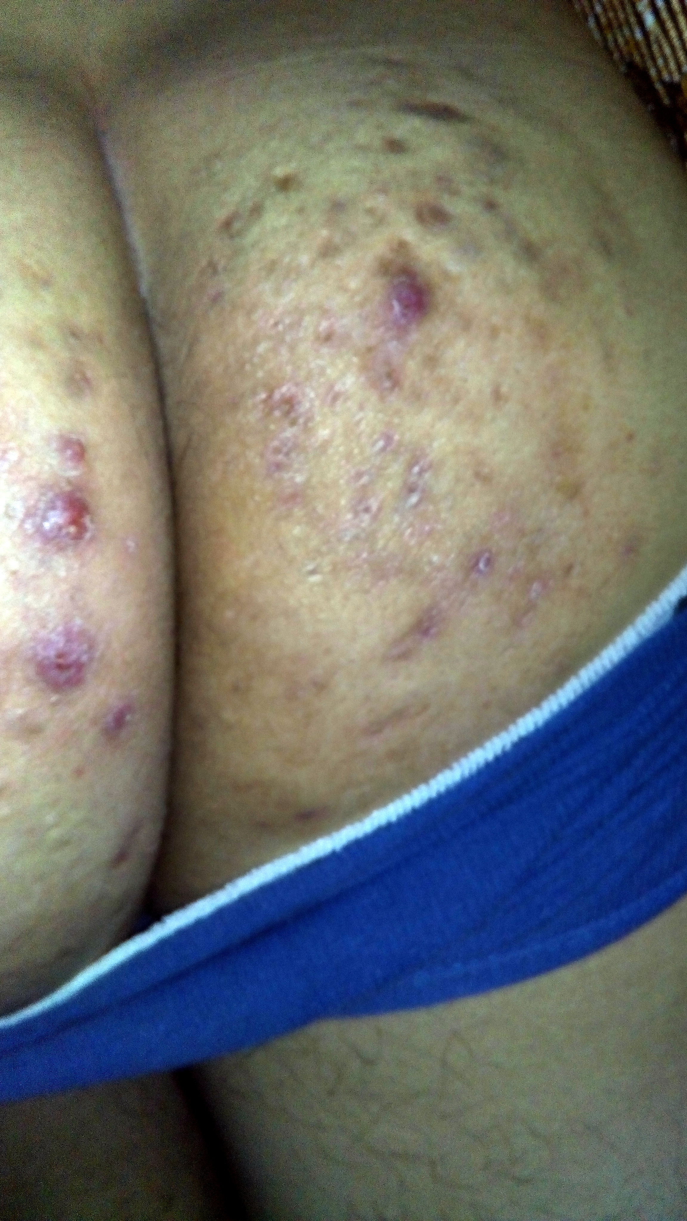 Como los médicos revelan la psoriasis