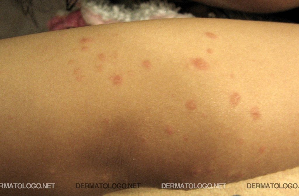 Que se distingue la dermatitis alérgica de la eccema
