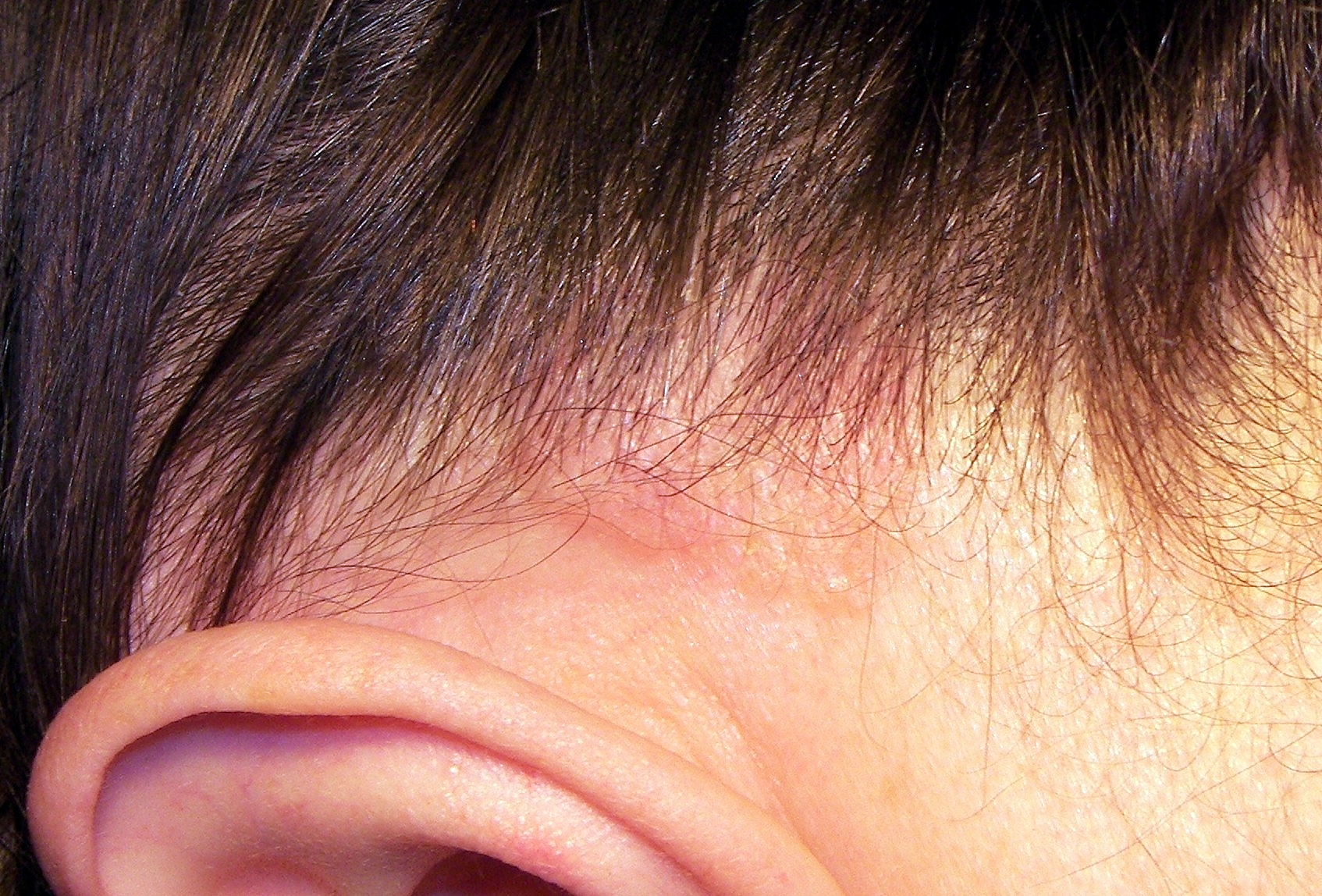 La diagnosis atopicheskogo de la dermatitis a los niños sobre un año