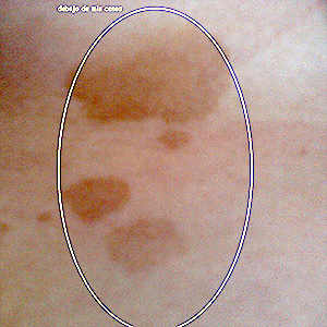 La fototerapia para la persona las manchas de pigmento