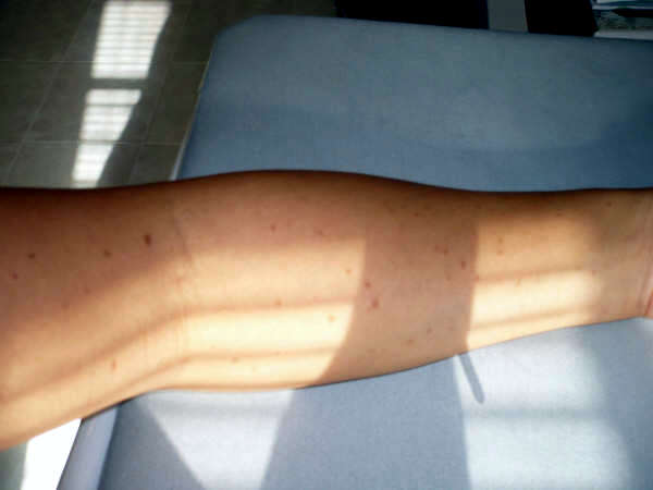 Manchas en los brazos marrones