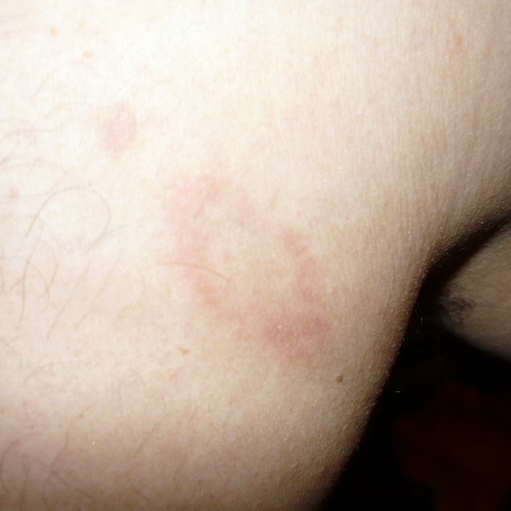 La diferencia del lupus de la psoriasis