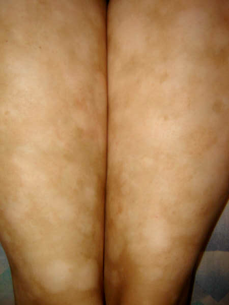 Manchas blancas dermatitis atopica