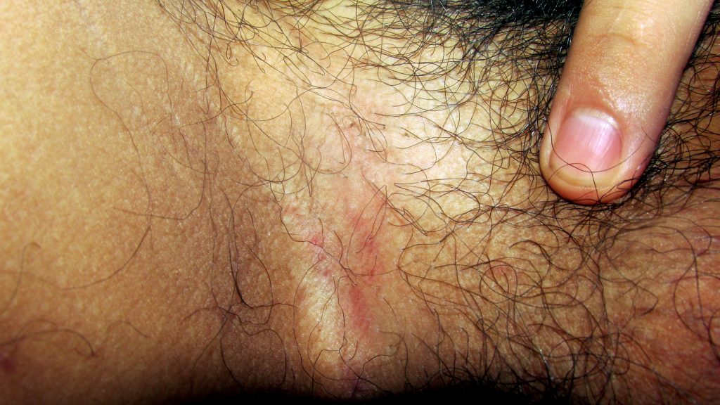 irritación entre las piernas