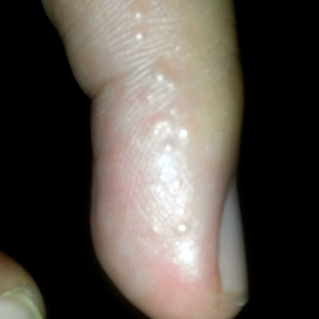 Atopichesky la dermatitis a los niños de la foto que curar