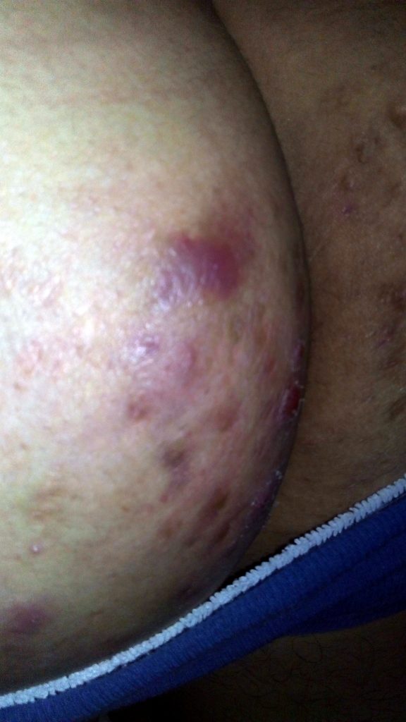Granos en las nalgas tratamiento