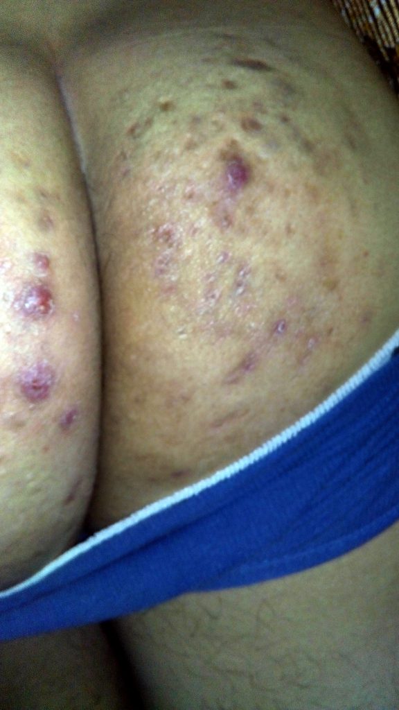 Granos en las nalgas tratamiento