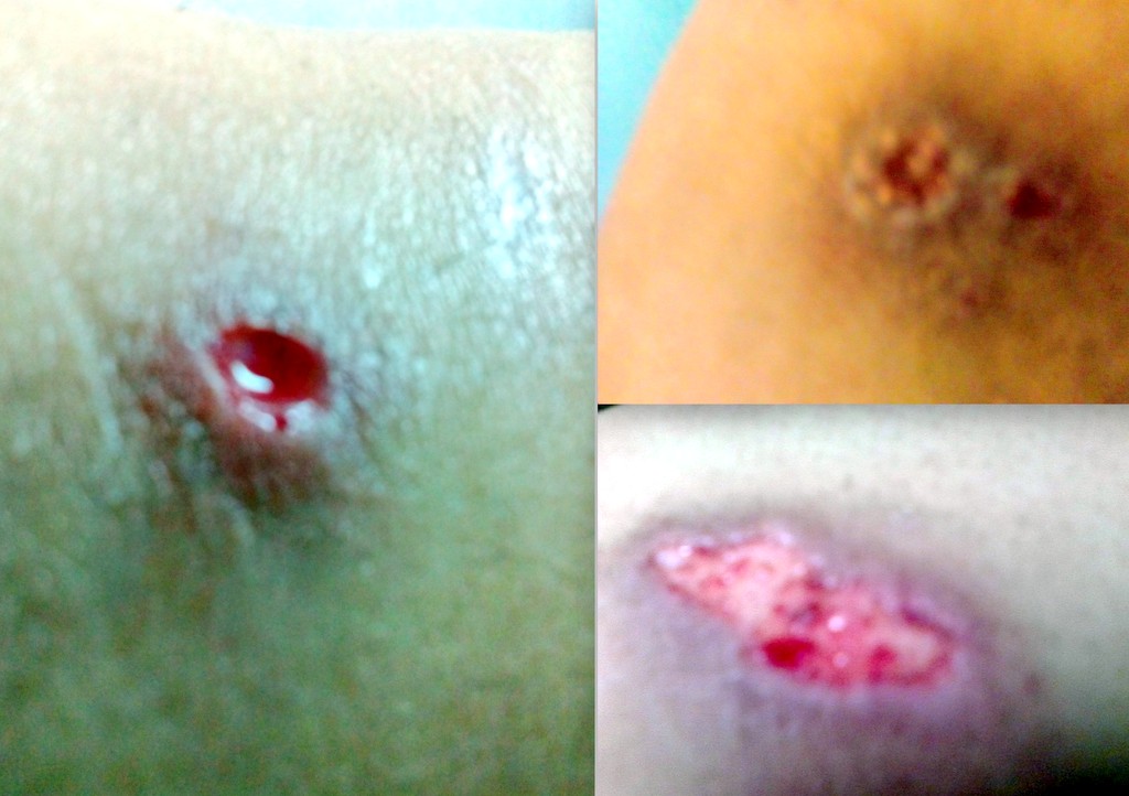 La osteocondrosis de la hernia el foro