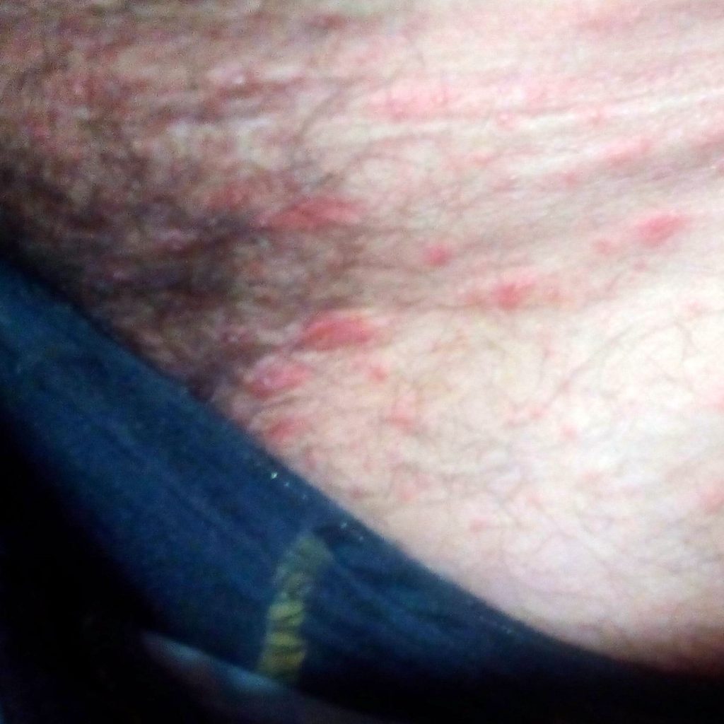 Sorbent atopichesky la dermatitis