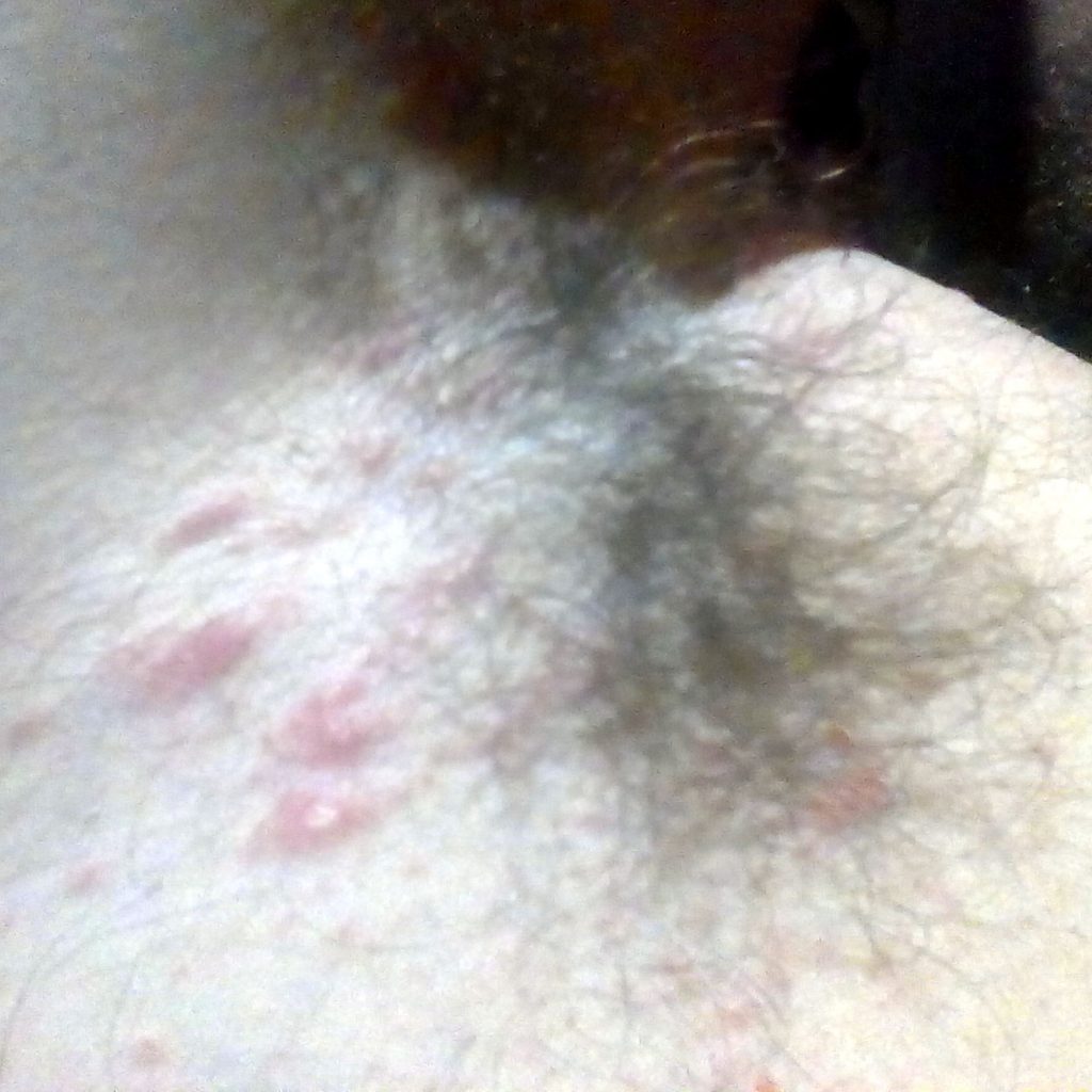 sarpullido en la ingle