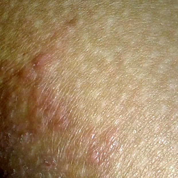 me sale sangre por el ano granos que pican por las noches en torno al ano me sale sangre por el ano granos que pican por las noches en torno al ano