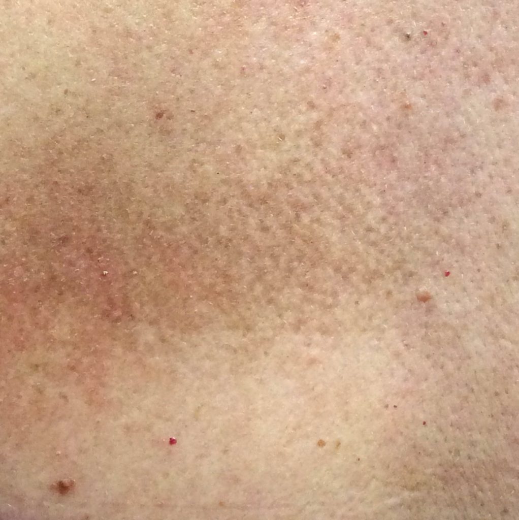 De que salen las manchas de pigmento en el cuerpo