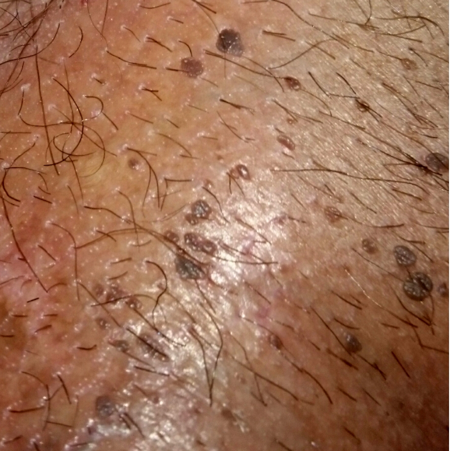 porque salen verrugas porque salen verrugas en el cuello tratamiento l 225 ser porque salen verrugas porque salen verrugas en el cuello tratamiento l 225 ser