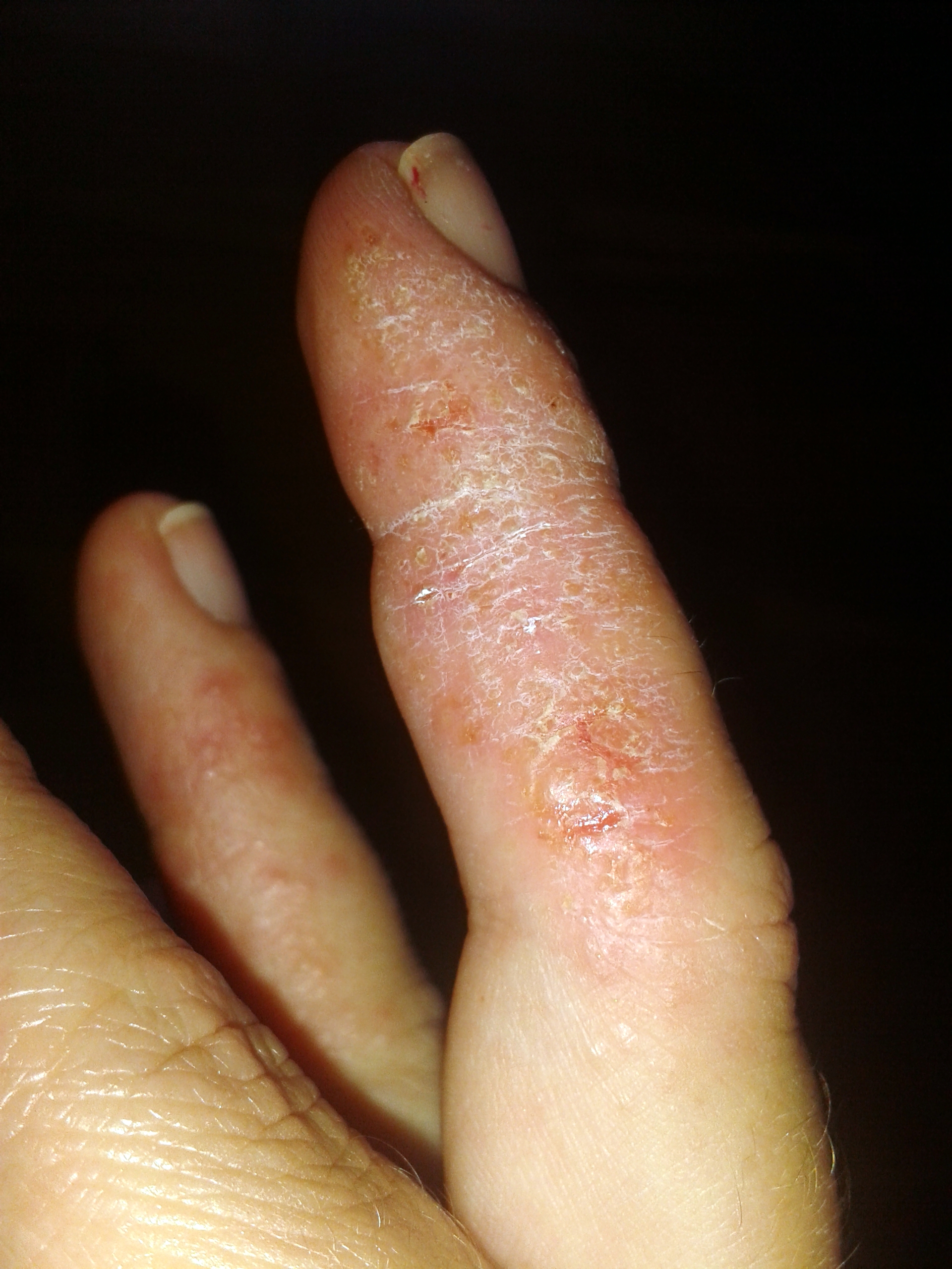 Las recomendaciones del tratamiento atopicheskogo de la dermatitis a los niños