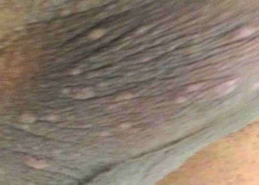 Acne en los testiculos fotos Acne en los testiculos fotos