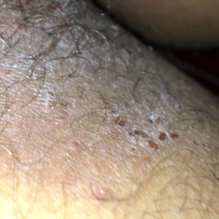fotos de micosis en la ingle