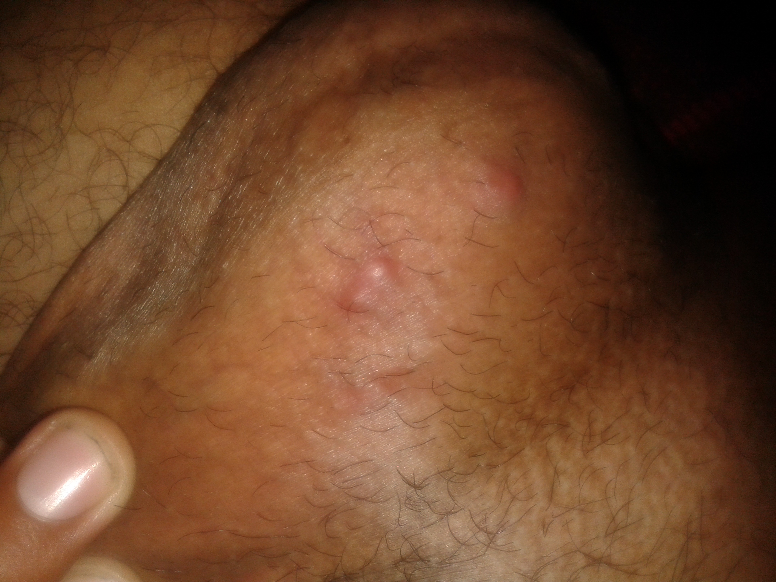 Granos en las nalgas tratamiento