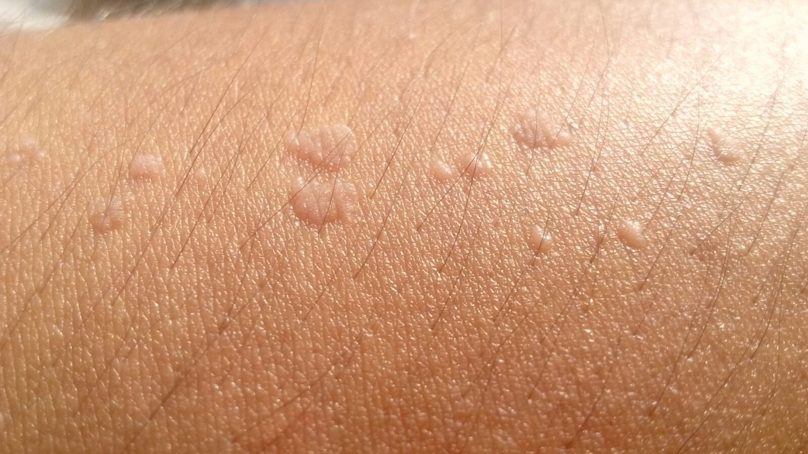 tratament antiviral papilom