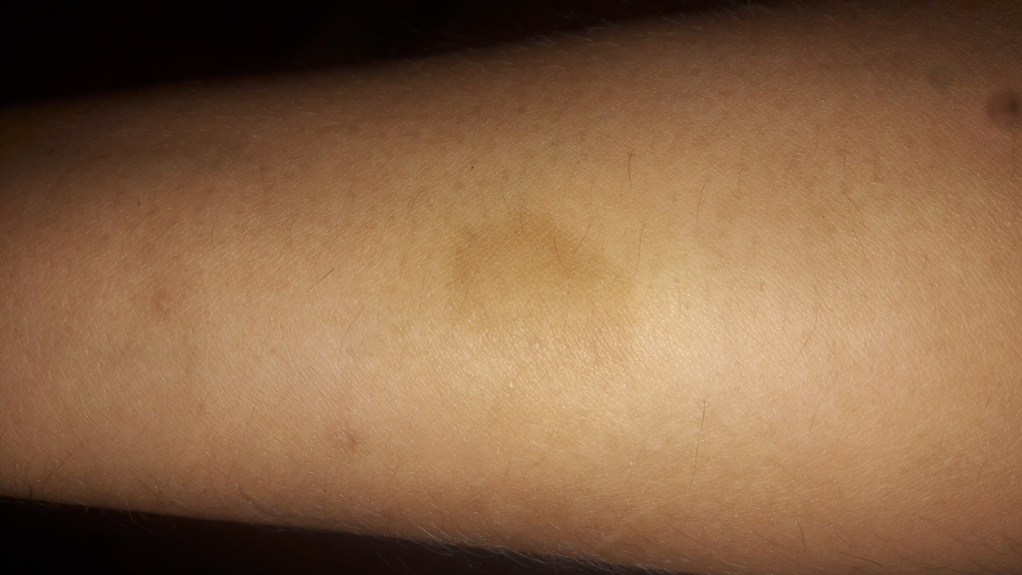 Dermatitis atopica manchas marrones