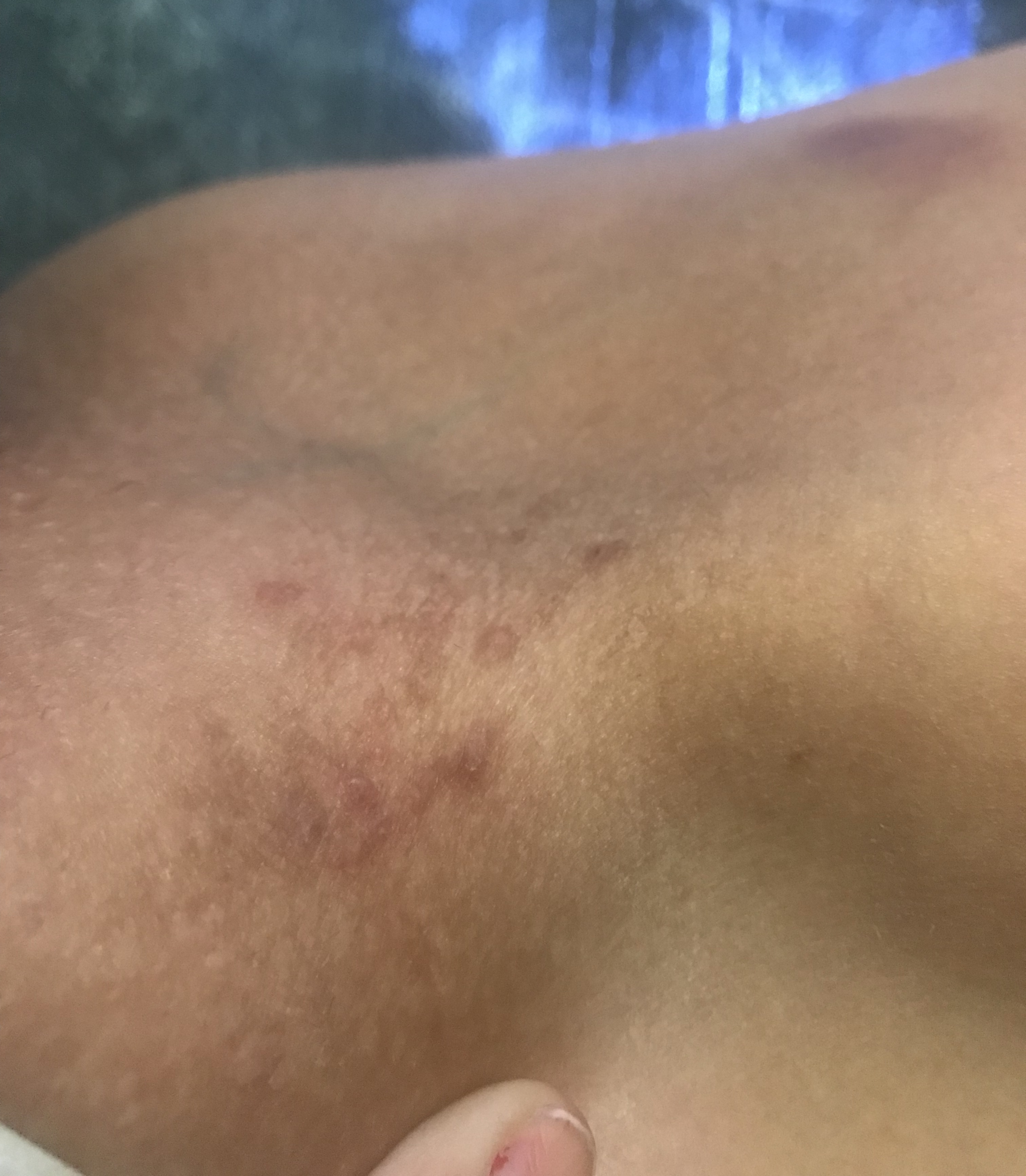 Foliculitis postdepilacion