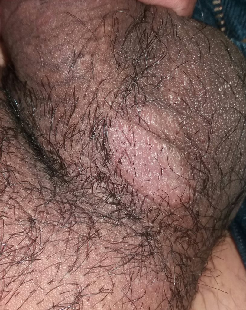 Fotos testiculos granos los en