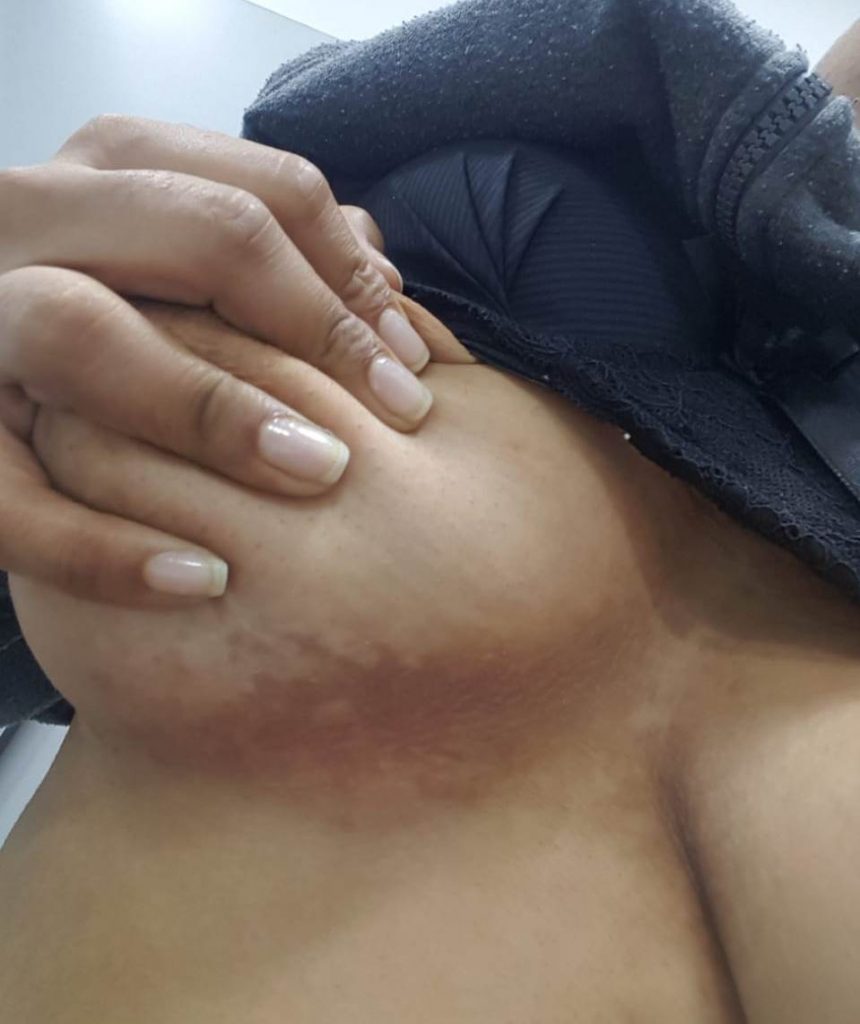 imagenes de manchas en medio de los senos